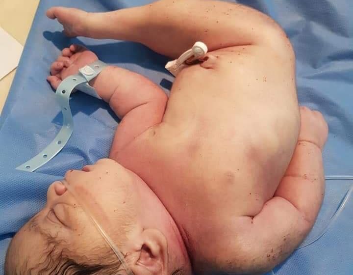  Iraqi child born with rare “mermaid” syndrome in Muthanna